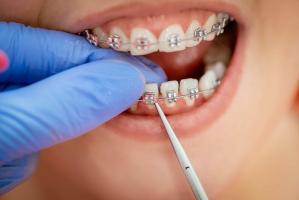 Nha khoa niềng răng dưới 30 triệu uy tín nhất Hà Nội