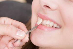 Lưu ý quan trọng nhất khi dán sứ Veneer