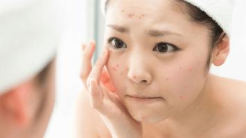 Địa chỉ nặn mụn chuẩn y khoa ở Quận 5, TP. HCM nổi tiếng nhất
